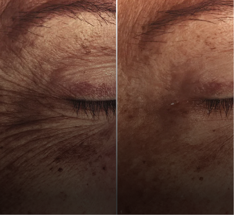 We tackled sun damage with a series of peels and at-home tyrosinase inhibitors.