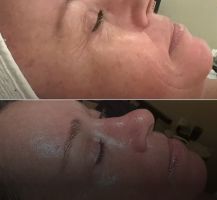 We tackled sun damage with a series of peels and at-home tyrosinase inhibitors.