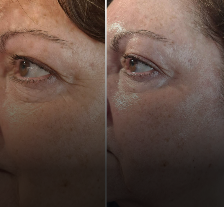 We tackled sun damage with a series of peels and at-home tyrosinase inhibitors.
